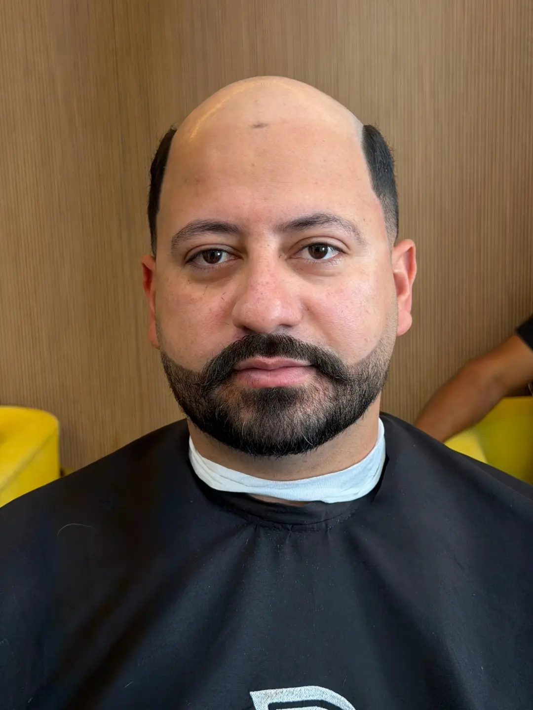 Cliente 01 antes da aplicação da prótese capilar